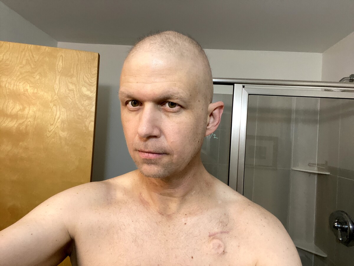 Clay Collins bald from chemotherapy
